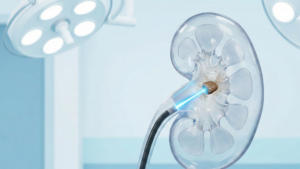 تقنية تفتيت حصى الكلى بالليزر RIRS في تايلاند بدون جراحة عبر بوابة الخليج الطبية